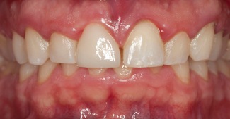 Front tooth repaired with dental restoratoin