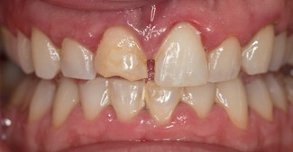 Cracked and decayed top front tooth