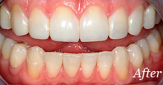 Perfectly aligned smile after orthodontic treatment