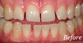 Smile with gaps between teeth before alignment