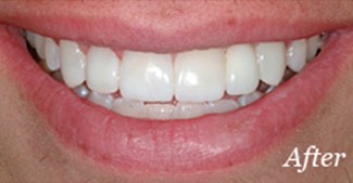 Smile after replacing missing top tooth