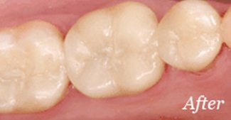 Metal fillings replaced with tooth-colored fillings