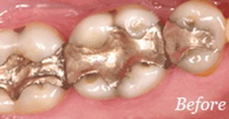 Three teeth with large metal fillings