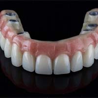 Implant denture resting on a dark table