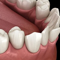 Illustration of crooked teeth