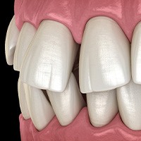 Illustration of gapped teeth