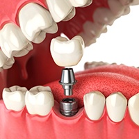 Diagram showing components of a dental implant in Covington