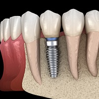 Diagram of an integrated dental implant in Covington