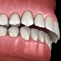 Illustration of an overbite