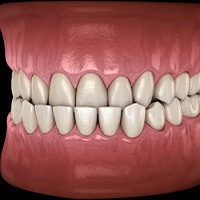 Illustration of an underbite