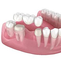 Illustration of a dental bridge being placed over three teeth