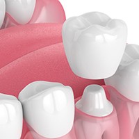 an example of a dental crown on a wax model