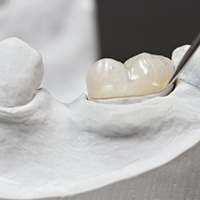 a 3D illustration of a dental crown