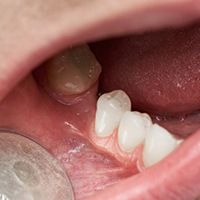 Closeup of mouth after tooth extraction in Covington 