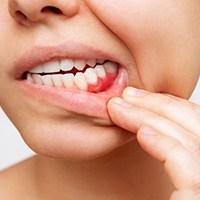 Woman pulling back her lip to reveal red gums
