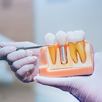 A 3D illustration of an implant bridge