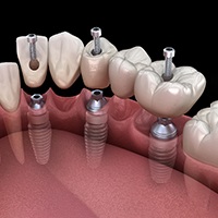 A 3D illustration of an implant denture