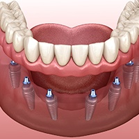 A 3D illustration of an implant denture