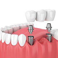 A diagram of an implant bridge