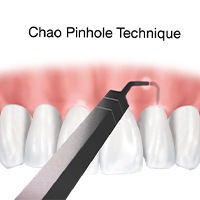 Animated Chao Pinhole technique process