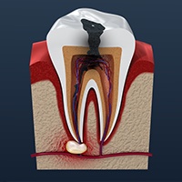 Animated tooth in need of root canal therapy