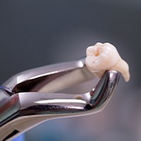 Metal clasp holding extracted tooth