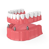 A diagram of implant-retained dentures in Covington.