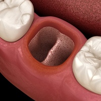 Illustration of empty socket in mouth after tooth extraction