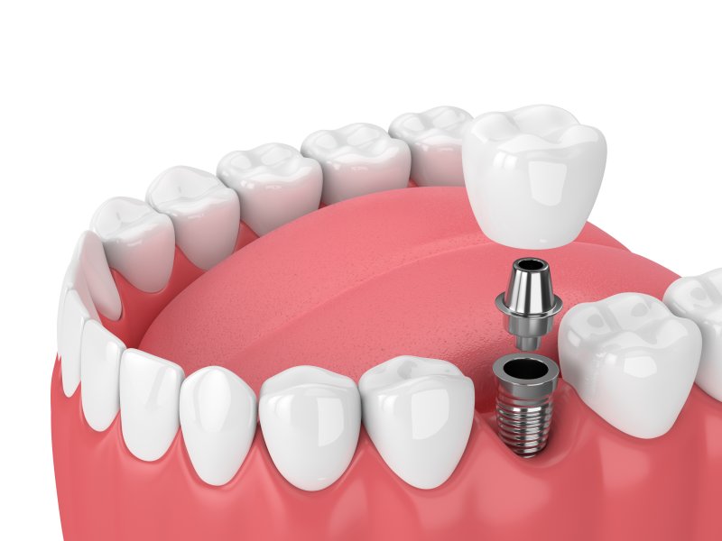 Dental implant