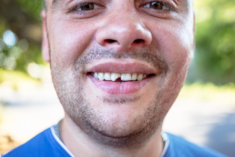 man smiling with chipped tooth