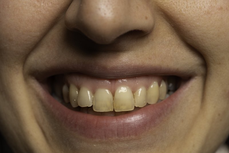 Woman smiling with stained teeth