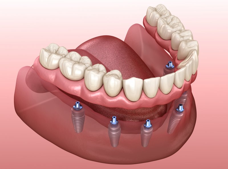 example of implant dentures 