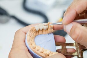 A bite impression with crowns fitted onto three teeth. 