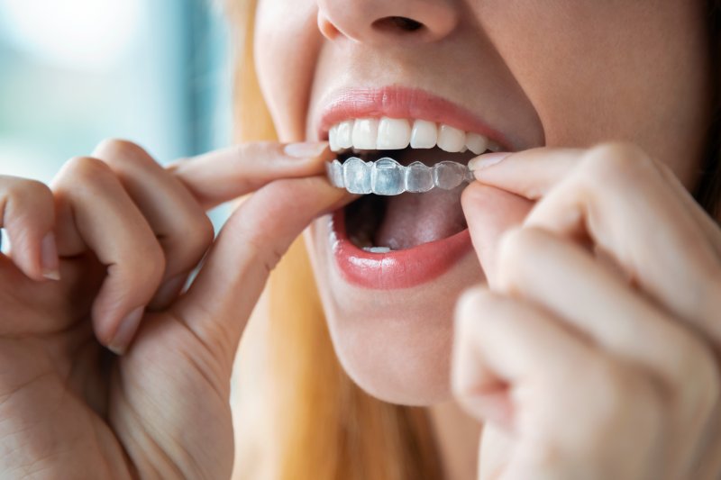 A woman putting an Invisalign aligner over her top teeth